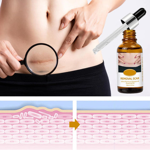 Acne Scar Removal Rejuvenation Serum | Scar, C section &amp; Stretch Mark Removal Oil for women