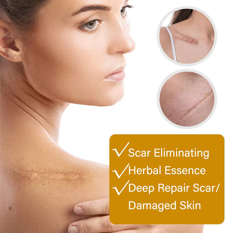 Acne Scar Removal Rejuvenation Serum | Scar, C section &amp; Stretch Mark Removal Oil for women
