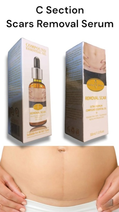Acne Scar Removal Rejuvenation Serum | Scar, C section &amp; Stretch Mark Removal Oil for women