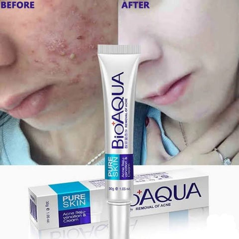 BIOAQUA Anti Acne Cream Acne Scar Removal Cream | Best Quality Scar Removal Cream 30g( Original )